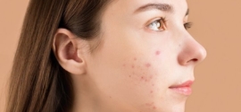 7 Produk Skincare yang Bisa Bantu Kamu Atasi Jerawat Bandel_banner