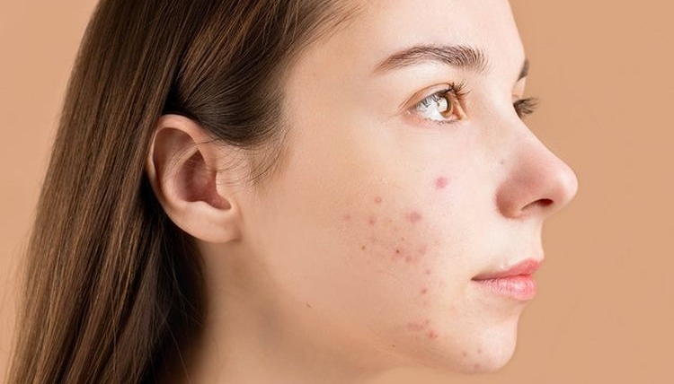 7 Produk Skincare yang Bisa Bantu Kamu Atasi Jerawat Bandel_banner