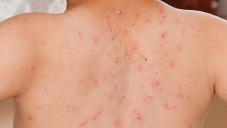 Baca.today-Waspada Campak! Pahami Gejala, Pengobatan dan Cara Pencegahannya