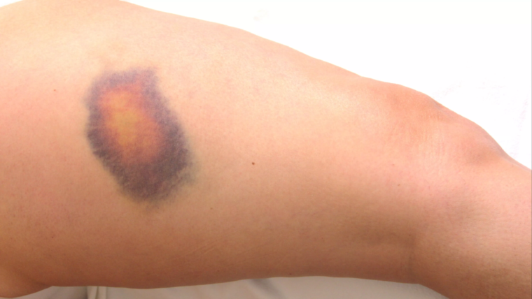 Baca.today- 11 Penyebab Timbulnya Memar Tanpa Sebab di Badan