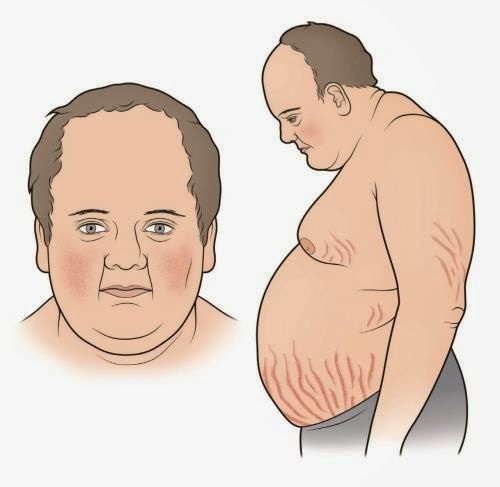 Baca.today-Sindrom Cushing: Gejala, Penyebab, & Pengobatan