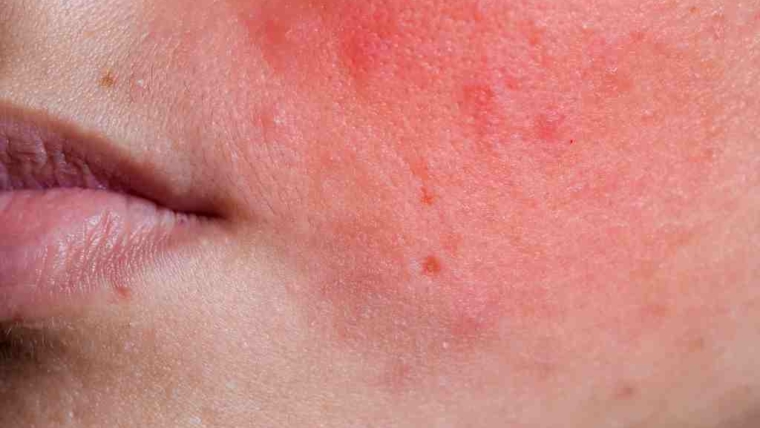 Baca.today-Kulit Sering Kemerahan? Ini Tanda Kulitmu Sensitif