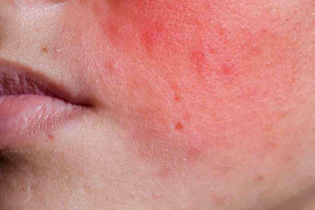 Baca.today-Kulit Sering Kemerahan? Ini Tanda Kulitmu Sensitif